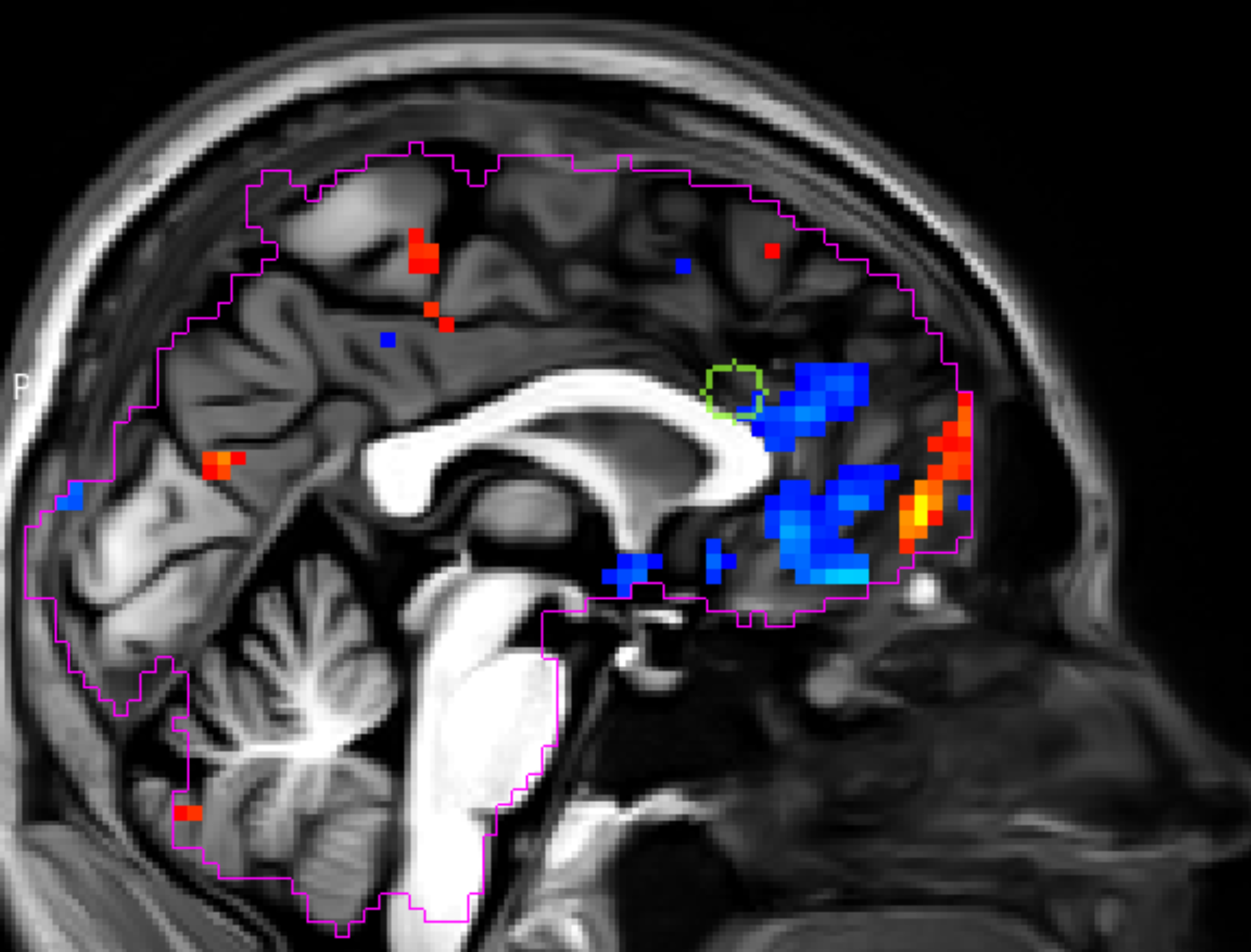 Changes in brain activity elicited with low-intensity focused ultrasound